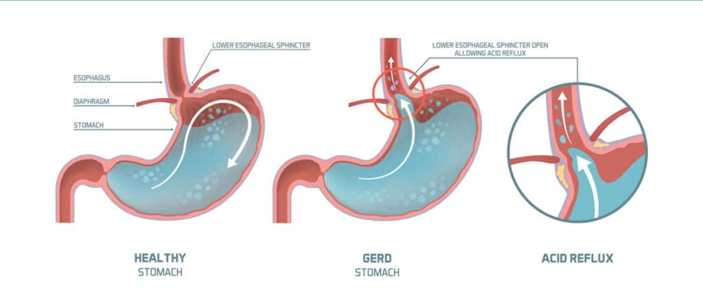 Foods that cause acid reflux cough