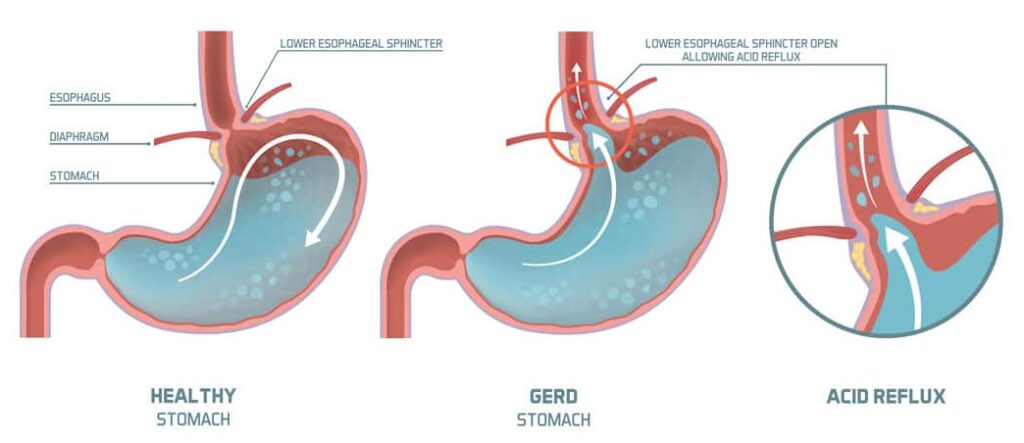 gerd-infographic