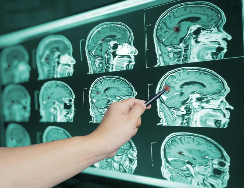 A person pointing at brain injury scans to determine how to get rid of metallic taste