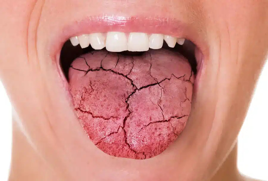 A person with a bitter taste in mouth caused by dry mouth, also known as xerostomia.