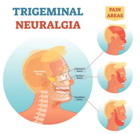 Symptoms of Trigeminal Neuralgia